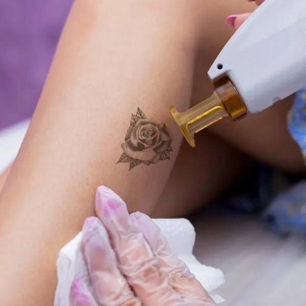 img-eliminar-tatuajes-medellin-1