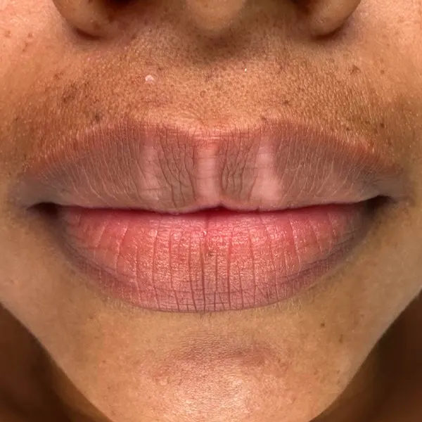 Img-DaniOsorio-ServicioLabios_Hijo_borrado-de-labios-en-medellin